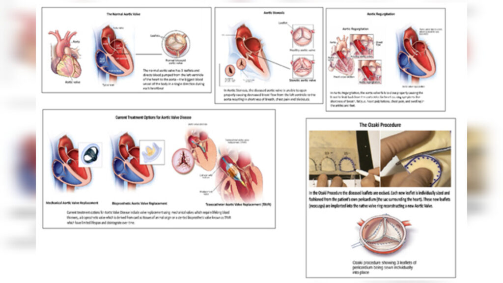 NEIGRIHMS Saves Lives by Performing Advanced Heart Valve Replacement Surgery