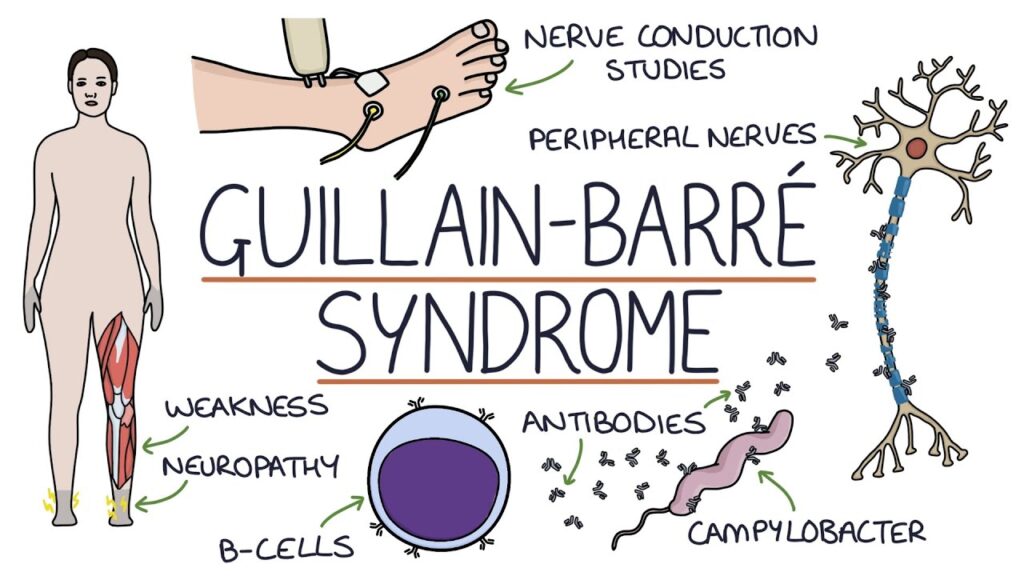 Meghalaya Health Department Issues Public Advisory on Guillain-Barre’ Syndrome