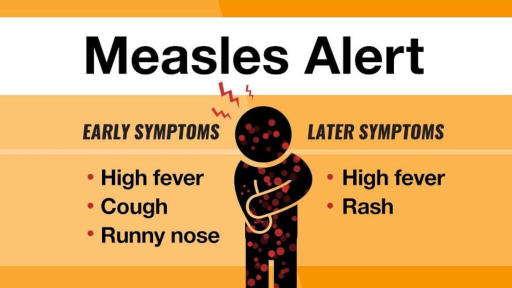 Heightened Measles Alert Issued in East Khasi Hills Amid Regional Outbreak Concerns